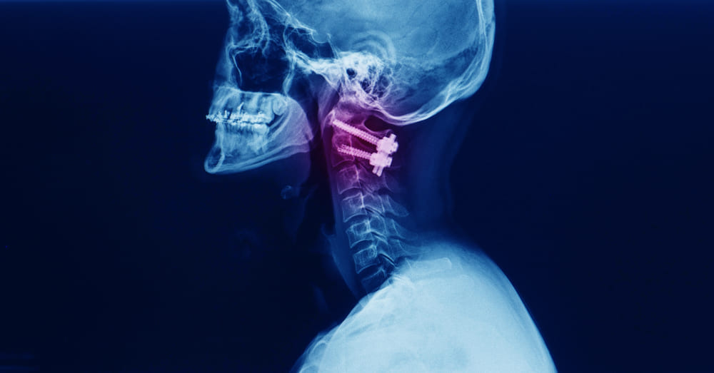 Symptoms Of Failed Cervical Fusion