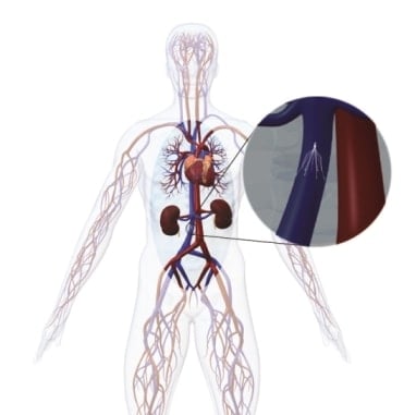 IVC filter